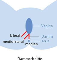 Die drei Arten des Dammschnittes (Episiotomie)