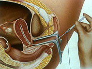 Insemination - Künstliche Befruchtung