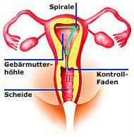 Intrauterinpessar in der Variante der Zahl "7"