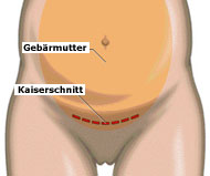 Der Kaiserschnitt wird horizontal an der Schamhaargrenze vorgenommen