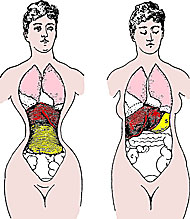 Organverlagerung durch das Korsett