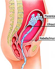 Nach der Geburt eines Kindes wird die Plazenta unter Wehen abgestossen