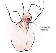 Phimose - verengte Vorhaut beim Penis