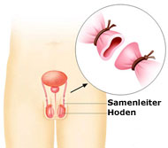 Sterilisation das Mannes
